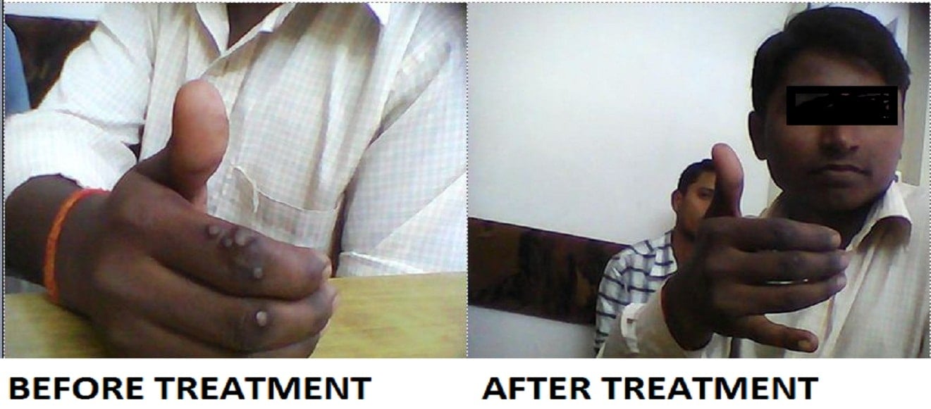 TREATMENT OF WARTS