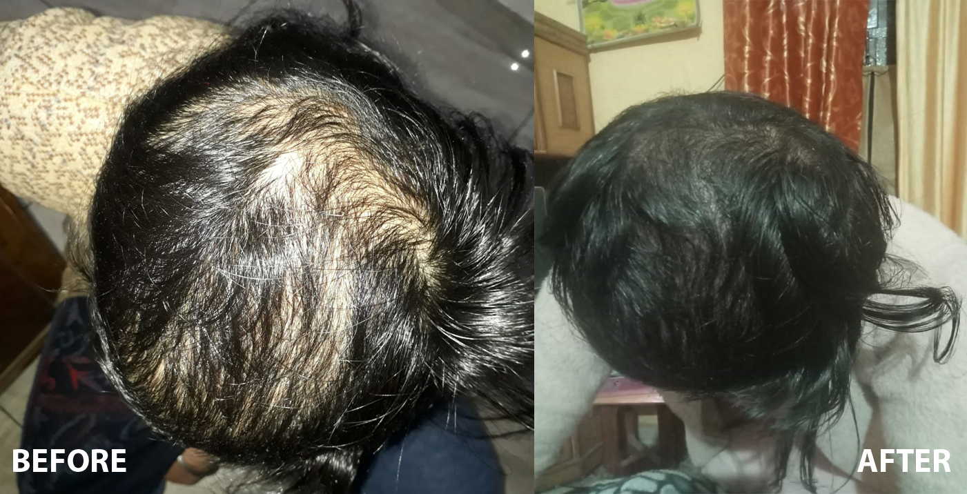 Hair Fall and Baldness